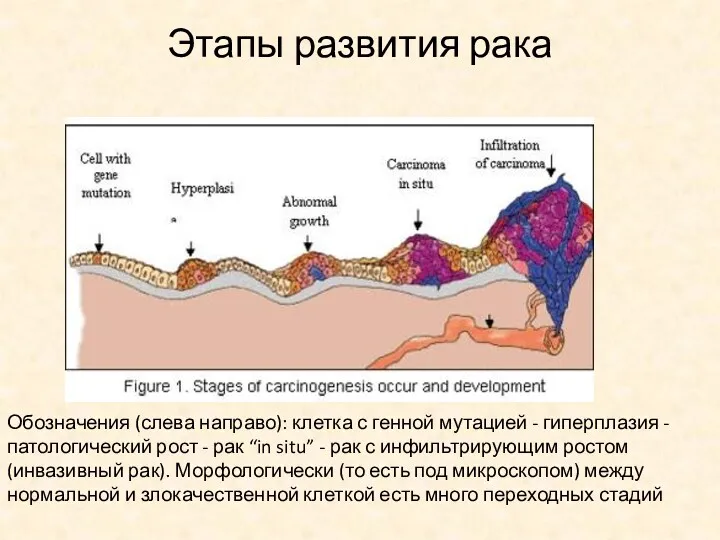 Этапы развития рака Обозначения (слева направо): клетка с генной мутацией