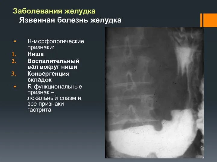 Заболевания желудка Язвенная болезнь желудка R-морфологические признаки: Ниша Воспалительный вал вокруг ниши Конвергенция