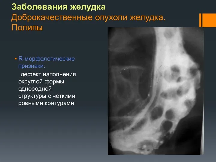 Заболевания желудка Доброкачественные опухоли желудка. Полипы R-морфологические признаки: дефект наполнения