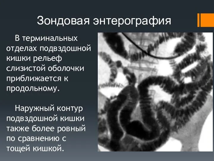 Зондовая энтерография В терминальных отделах подвздошной кишки рельеф слизистой оболочки приближается к продольному.