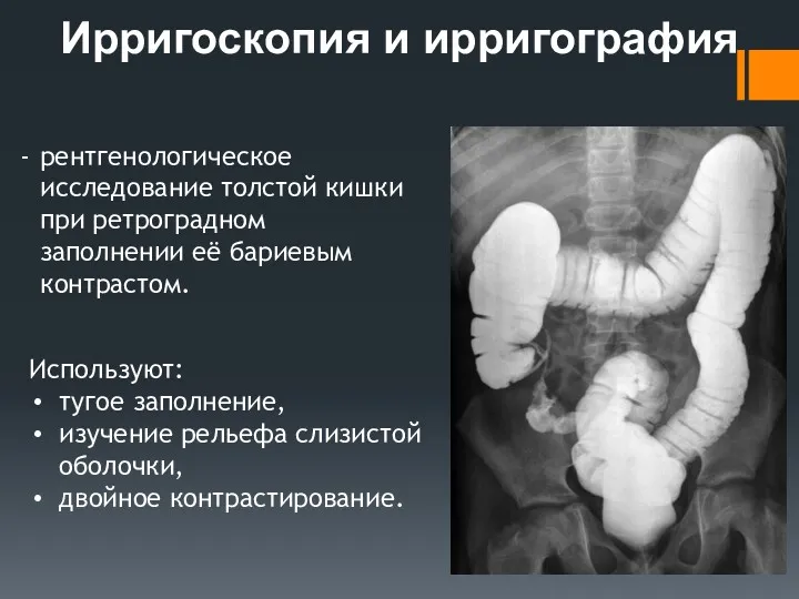 Ирригоскопия и ирригография рентгенологическое исследование толстой кишки при ретроградном заполнении её бариевым контрастом.