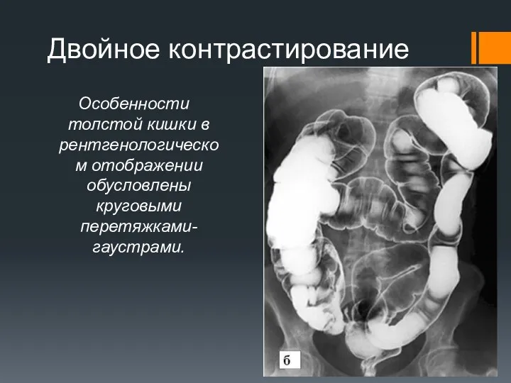 Двойное контрастирование Особенности толстой кишки в рентгенологическом отображении обусловлены круговыми перетяжками-гаустрами.