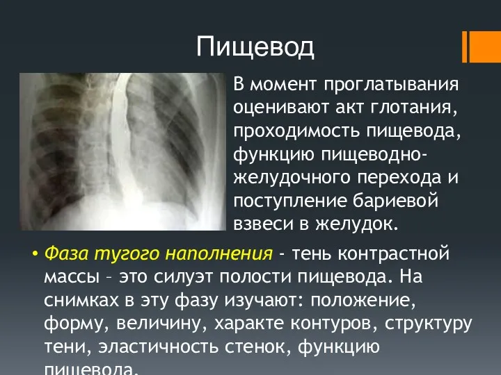 Пищевод В момент проглатывания оценивают акт глотания, проходимость пищевода, функцию пищеводно-желудочного перехода и