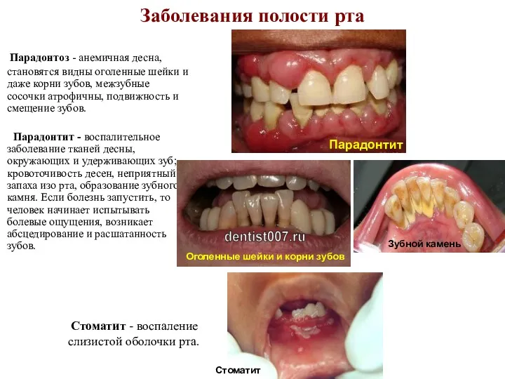 Заболевания полости рта Парадонтоз - анемичная десна, становятся видны оголенные