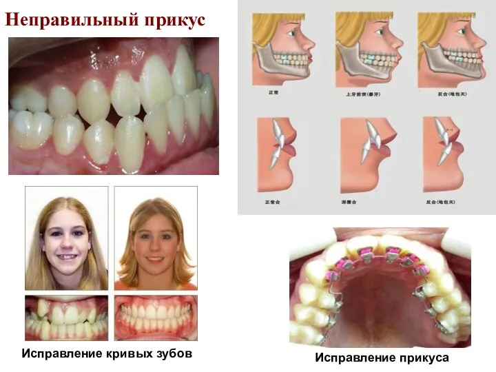 Неправильный прикус Исправление кривых зубов Исправление прикуса