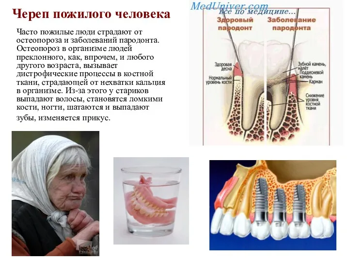Череп пожилого человека Часто пожилые люди страдают от остеопороза и