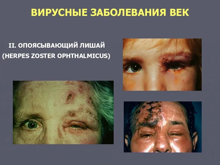 ВИРУСНЫЕ ЗАБОЛЕВАНИЯ ВЕК II. ОПОЯСЫВАЮЩИЙ ЛИШАЙ (HERPES ZOSTER OPHTHALMICUS)