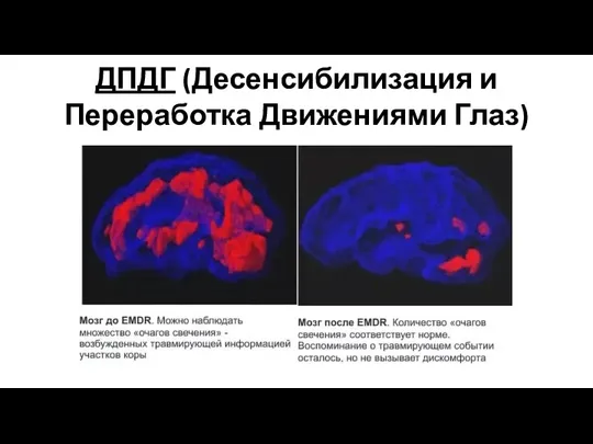 ДПДГ (Десенсибилизация и Переработка Движениями Глаз)