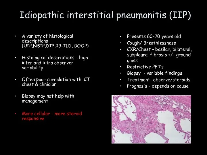 Idiopathic interstitial pneumonitis (IIP) A variety of histological descriptions (UIP,NSIP,DIP,RB-ILD,
