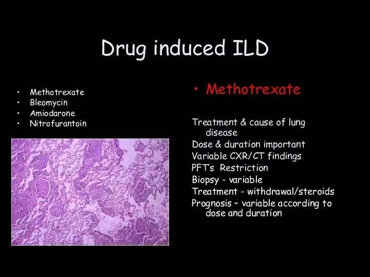 Drug induced ILD Methotrexate Bleomycin Amiodarone Nitrofurantoin Methotrexate Treatment &