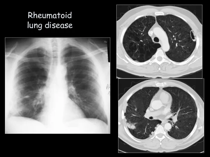 Rheumatoid lung disease