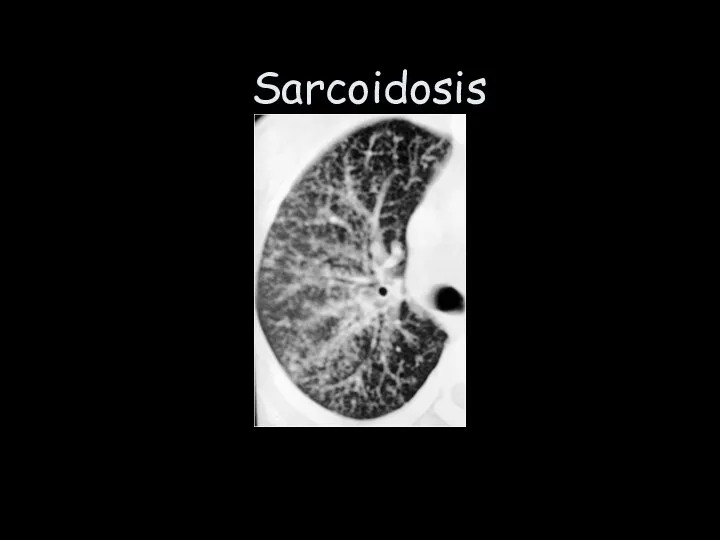 Sarcoidosis