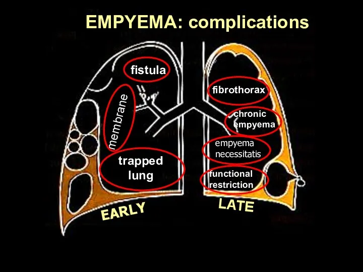 EARLY LATE fistula trapped lung membranes fibrothorax chronic empyema empyema necessitatis functional restriction EMPYEMA: complications