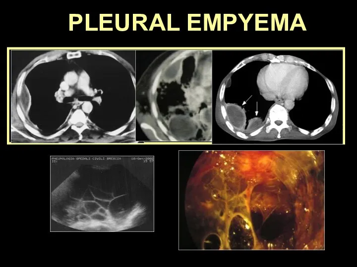 PLEURAL EMPYEMA