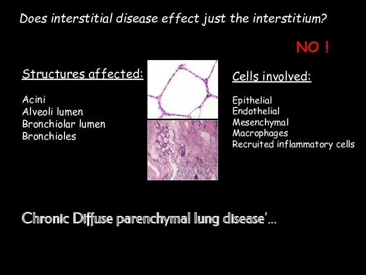 Does interstitial disease effect just the interstitium? NO ! Structures