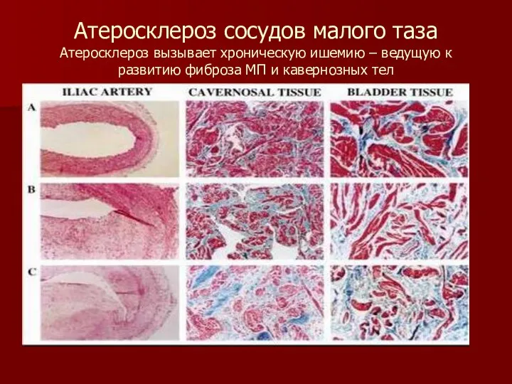 Атеросклероз сосудов малого таза Атеросклероз вызывает хроническую ишемию – ведущую