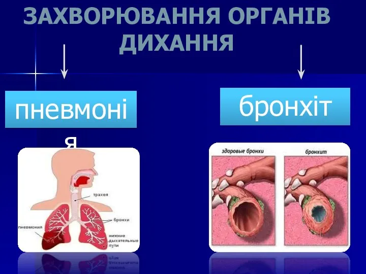 ЗАХВОРЮВАННЯ ОРГАНІВ ДИХАННЯ бронхіт пневмонія