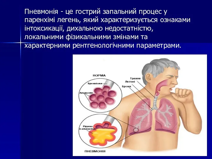 Пневмонія - це гострий запальний процес у паренхімі легень, який