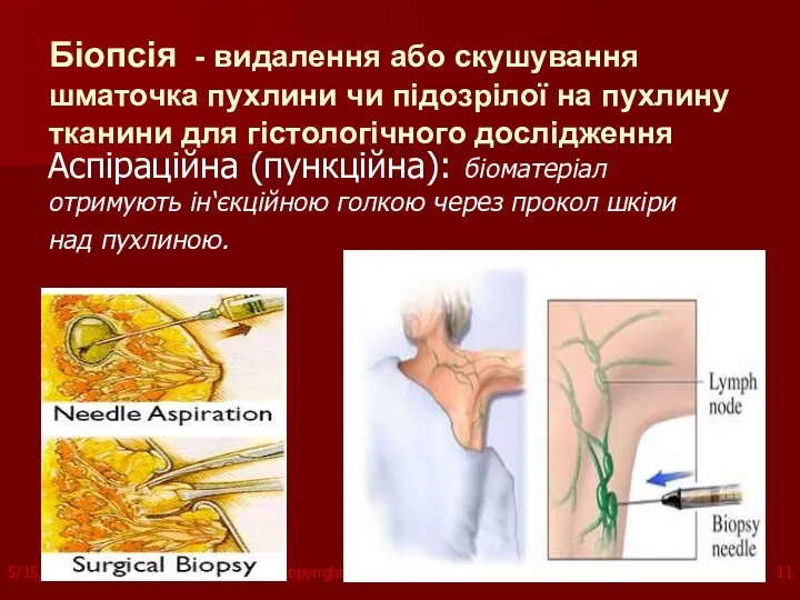 Біопсія - видалення або скушування шматочка пухлини чи підозрілої на пухлину тканини для