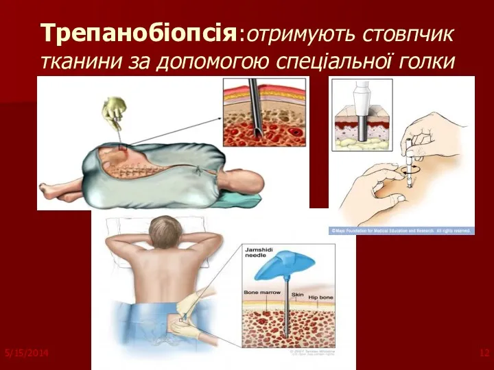 Трепанобіопсія:отримують стовпчик тканини за допомогою спеціальної голки 5/15/2014 copyright (your organization) 2003