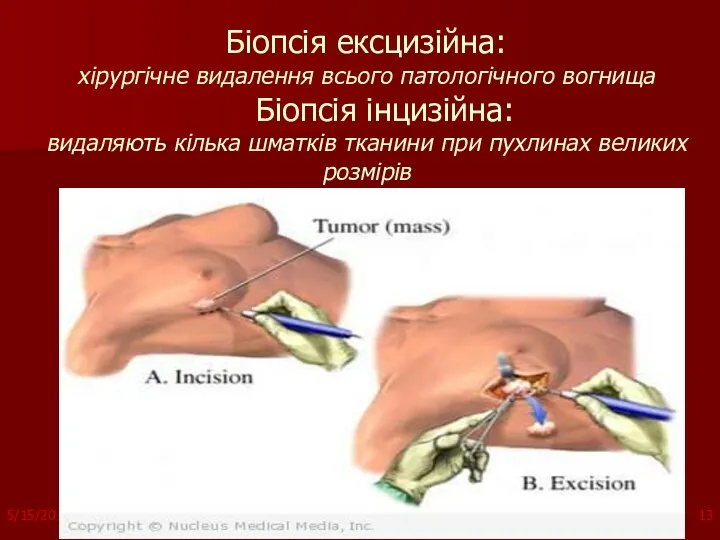 Біопсія ексцизійна: хірургічне видалення всього патологічного вогнища Біопсія інцизійна: видаляють кілька шматків тканини