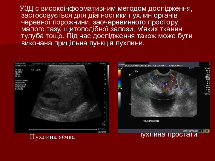 УЗД є високоінформативним методом дослідження, застосовується для діагностики пухлин органів черевної порожнини, заочеревинного