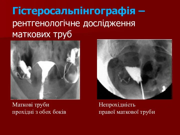 Гістеросальпінгографія – рентгенологічне дослідження маткових труб Непрохідність правої маткової труби Маткові труби прохідні з обох боків