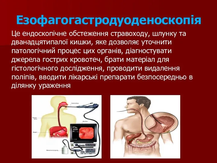 Езофагогастродуоденоскопія Це ендоскопічне обстеження стравоходу, шлунку та дванадцятипалої кишки, яке дозволяє уточнити патологічний