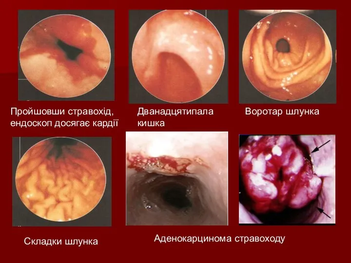 Пройшовши стравохід, ендоскоп досягає кардії Дванадцятипала кишка Воротар шлунка Складки шлунка Аденокарцинома стравоходу