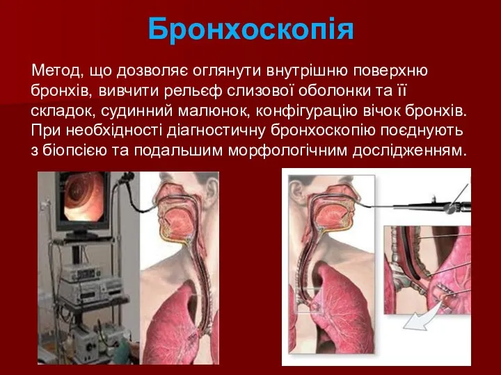 Бронхоскопія Метод, що дозволяє оглянути внутрішню поверхню бронхів, вивчити рельєф