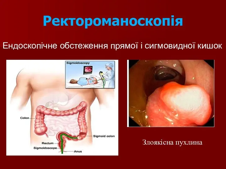 Ректороманоскопія Ендоскопічне обстеження прямої і сигмовидної кишок Злоякісна пухлина