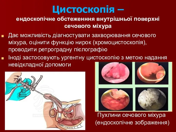 Цистоскопія – ендоскопічне обстеженння внутрішньої поверхні сечового міхура Дає можливість діагностувати захворювання сечового