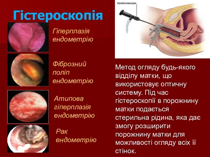 Гістероскопія Гіперплазія ендометрію Фіброзний поліп ендометрію Атипова гіперплазія ендометрію Рак ендометрію Метод огляду
