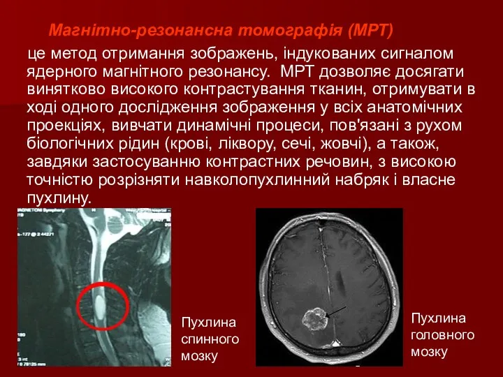 Магнітно-резонансна томографія (МРТ) це метод отримання зображень, індукованих сигналом ядерного магнітного резонансу. МРТ