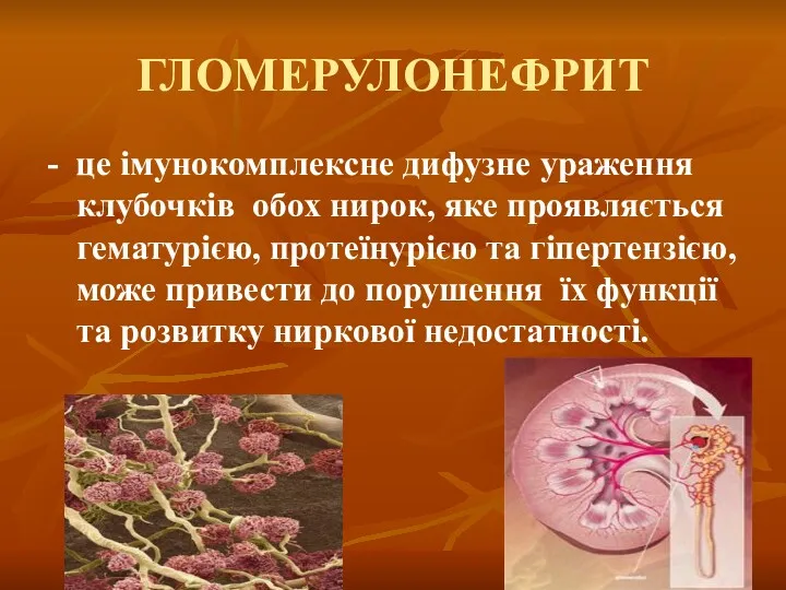 ГЛОМЕРУЛОНЕФРИТ - це імунокомплексне дифузне ураження клубочків обох нирок, яке проявляється гематурією, протеїнурією