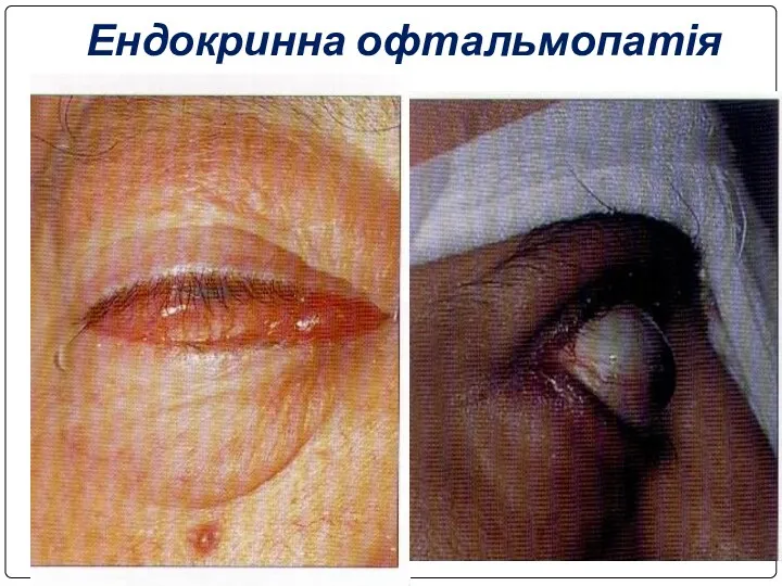 Ендокринна офтальмопатія