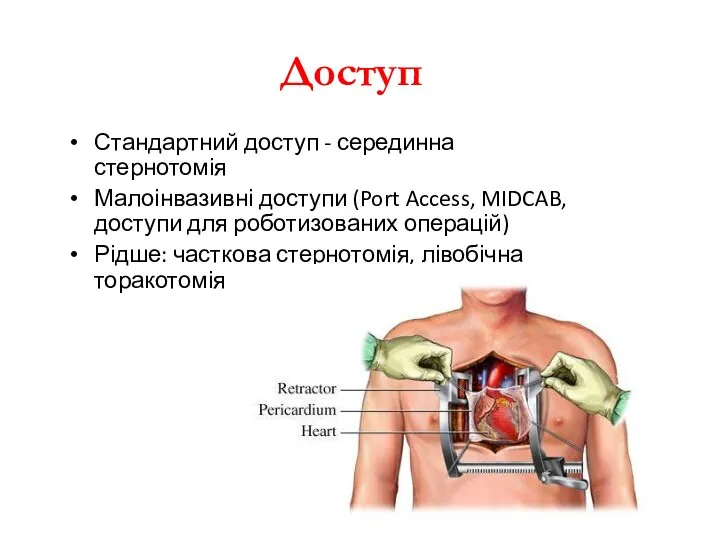 Доступ Стандартний доступ - серединна стернотомія Малоінвазивні доступи (Port Access, MIDCAB, доступи для