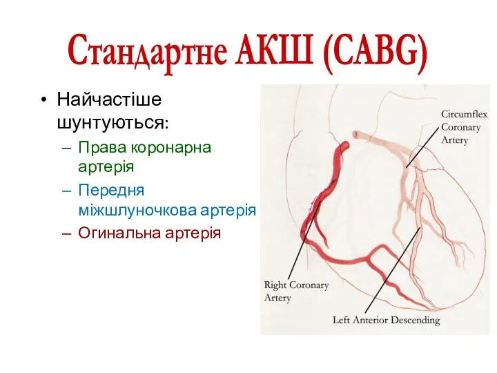 Найчастіше шунтуються: Права коронарна артерія Передня міжшлуночкова артерія Огинальна артерія Стандартне АКШ (CABG)