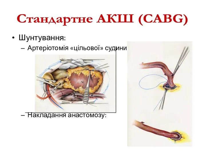 Шунтування: Артеріотомія «цільової» судини: Накладання анастомозу: Стандартне АКШ (CABG)