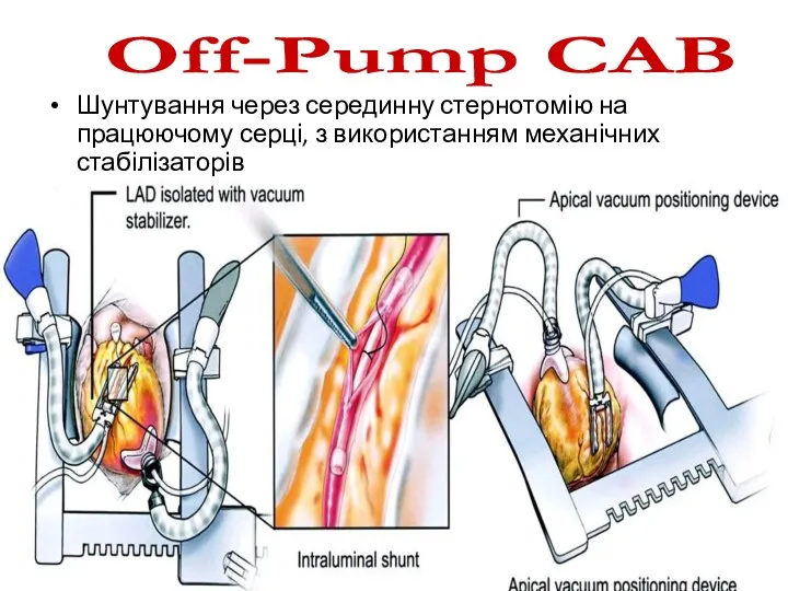 Шунтування через серединну стернотомію на працюючому серці, з використанням механічних стабілізаторів Off-Pump CAB