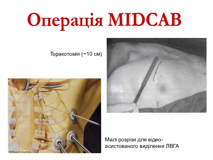 Малі розрізи для відео-асистованого виділення ЛВГА Торакотомія (~10 см) Операція MIDCAB