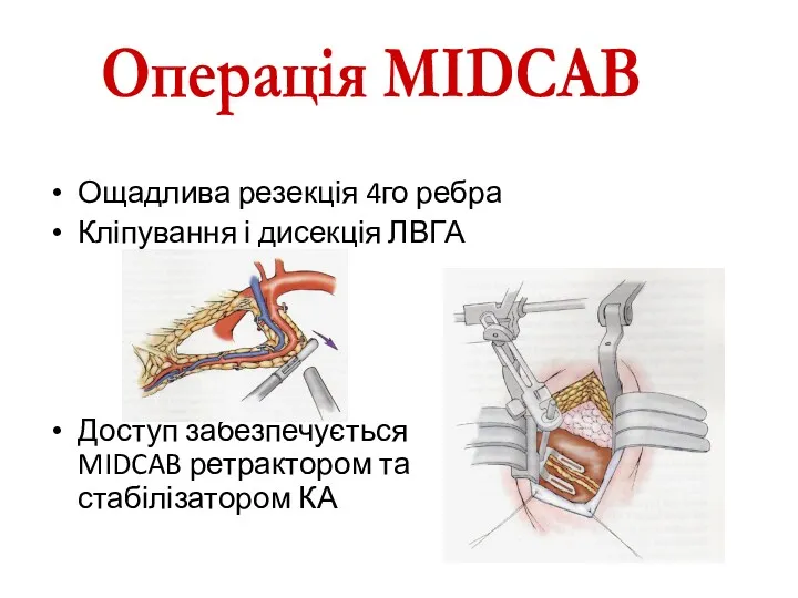 Ощадлива резекція 4го ребра Кліпування і дисекція ЛВГА Доступ забезпечується MIDCAB ретрактором та