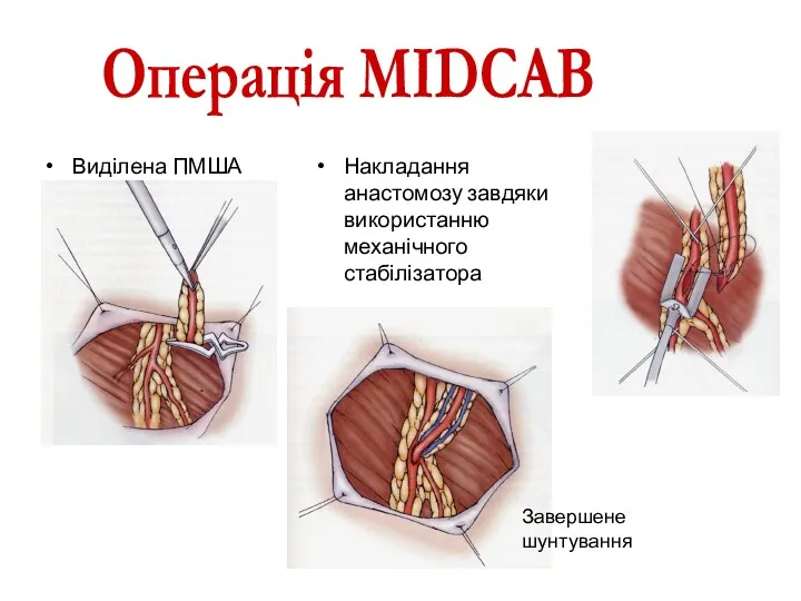 Виділена ПМША Накладання анастомозу завдяки використанню механічного стабілізатора Завершене шунтування Операція MIDCAB