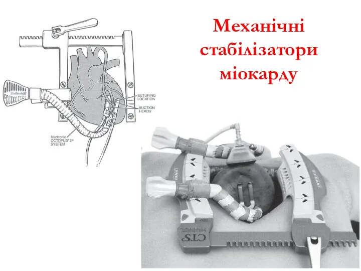 Механічні стабілізатори міокарду