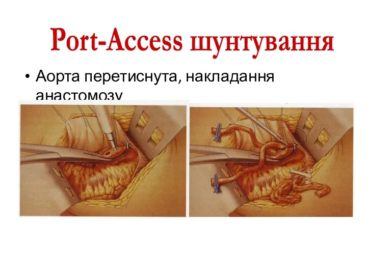 Аорта перетиснута, накладання анастомозу Port-Access шунтування