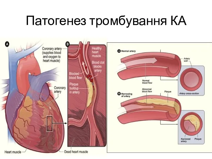 Патогенез тромбування КА