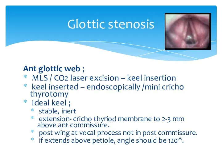 Glottic stenosis Ant glottic web ; MLS / CO2 laser excision – keel