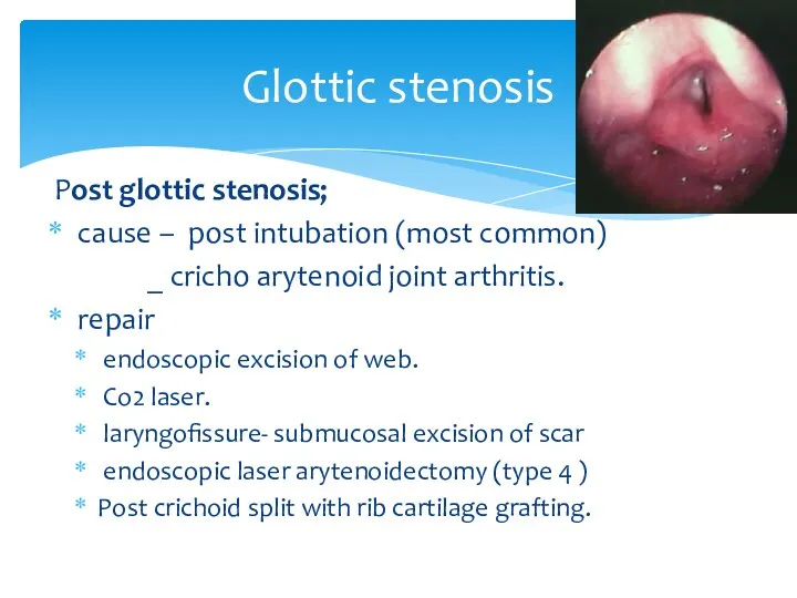 Glottic stenosis Post glottic stenosis; cause – post intubation (most common) _ cricho