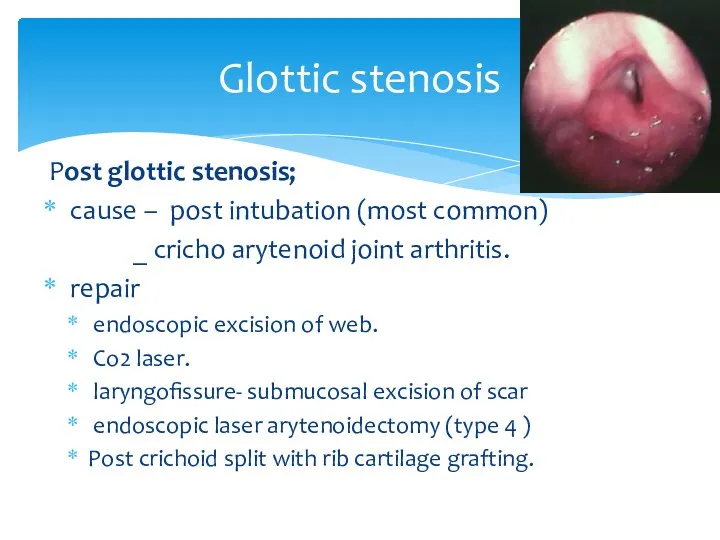 Glottic stenosis Post glottic stenosis; cause – post intubation (most