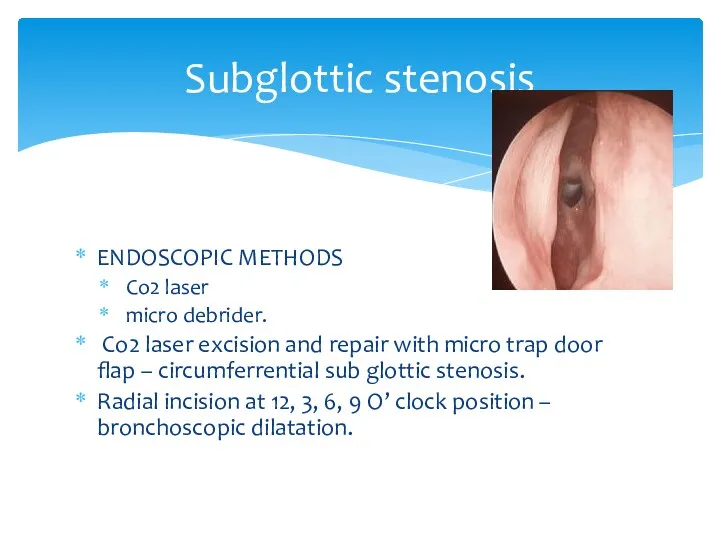 Subglottic stenosis ENDOSCOPIC METHODS Co2 laser micro debrider. Co2 laser excision and repair